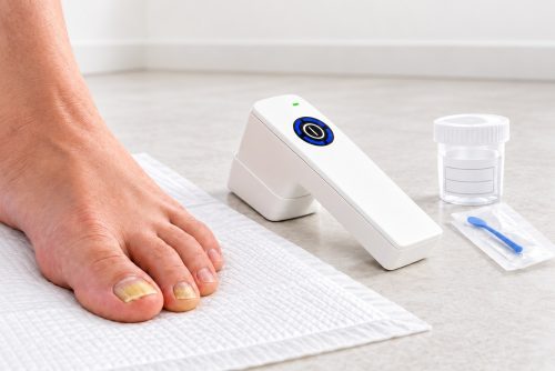 Illustration eines Fußes mit Nagelveränderungen auf weißer Unterlage neben einem Kaltplasmagerät und einem Probengefäß